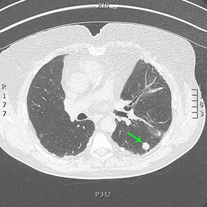 Early lung cancer in a man previously exposed to asbestos